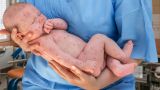 Роспотребнадзор: Ситуация с корью стабилизовалась после всплеска заболеваемости
